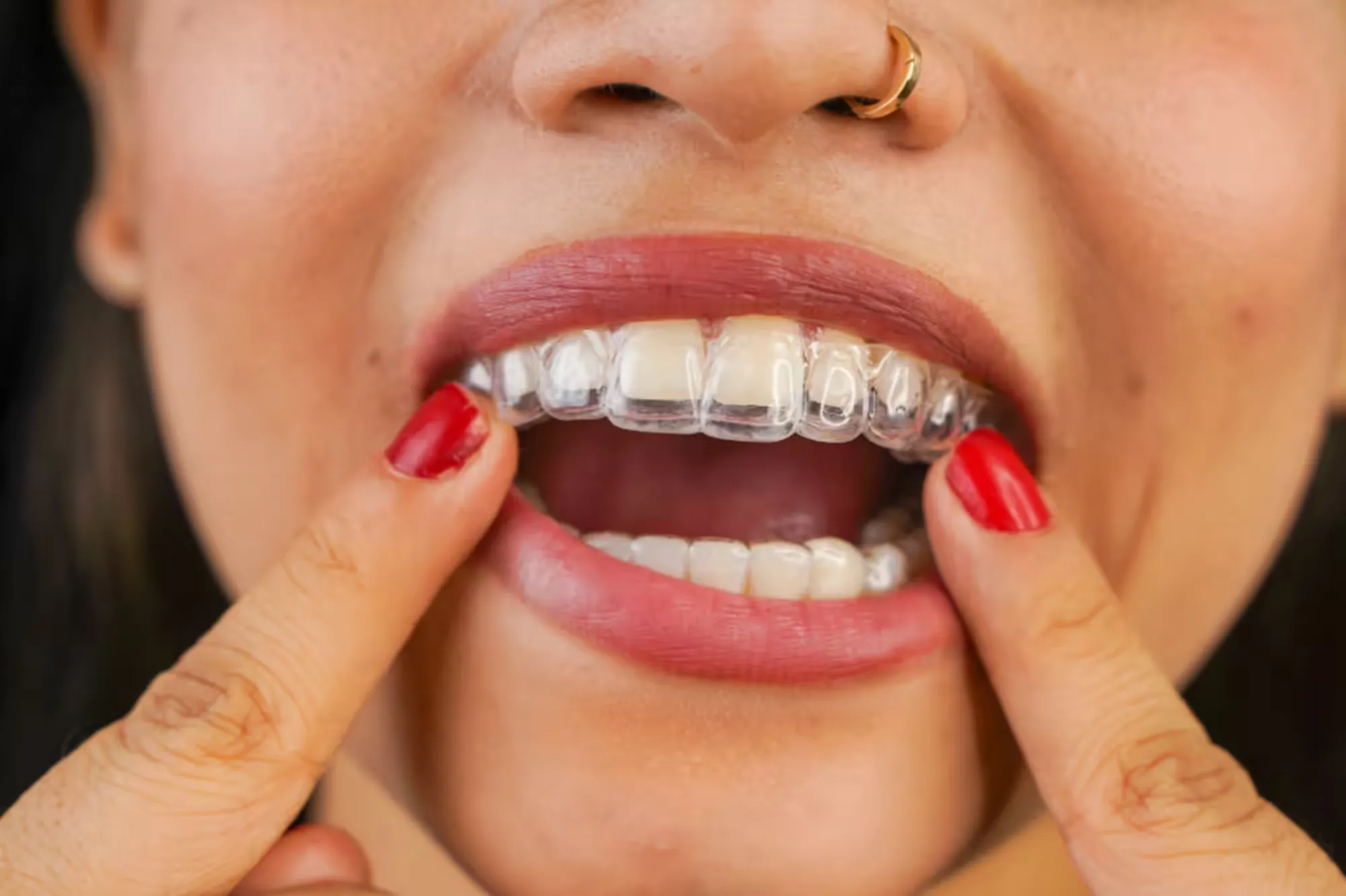 The Benefits of Clear Aligners Treatment in Chatham, NJ