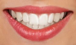 Clear Aligners Smile Clear Aligners Smile